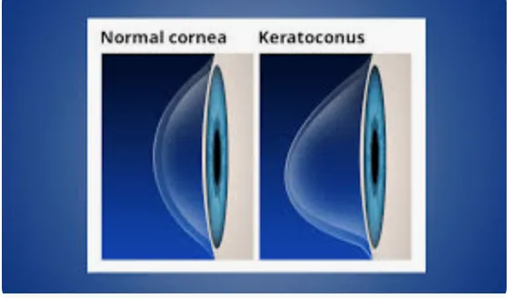 Kornea Hastalıkları